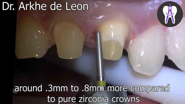 Amazing Case of Fractured Teeth Restored with Zirconia Crown #4k #C29 смотреть онлайн