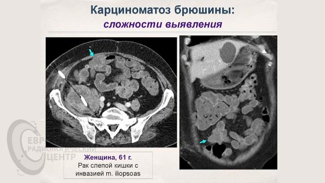 Роль компьютерной томографии в стадировании рака ободочной кишки. Екатерина Кульпина смотреть онлайн
