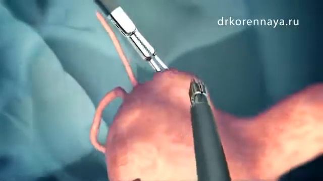 Лапароскопічне лікування міоми матки смотреть онлайн