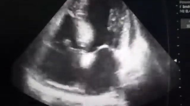 Передний инфаркт миокарда смотреть онлайн