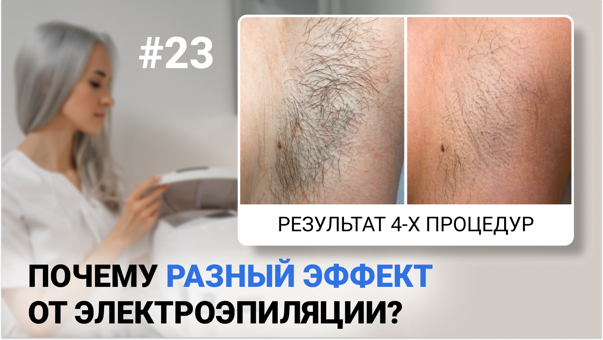 Урок №23. Не у всех одинаковый эффект от электроэпиляции! В чем разница? Обучение электроэпиляции смотреть онлайн