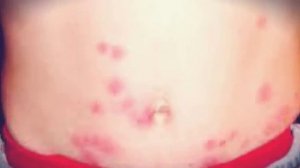 Укусы клопов на теле ребенка | Биотрикс-СЭС услуги по МО