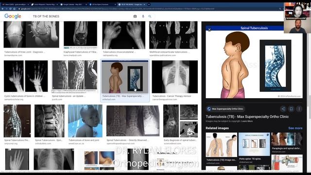 EXTRAPULMONARY TB смотреть онлайн