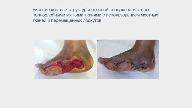Хирургия инфицированных форм синдрома диабетической стопы. смотреть онлайн