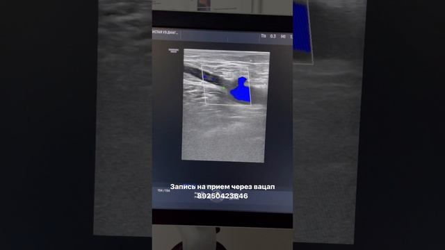 Тромбоза нет! Тромба нет! Варикоза нет! Узи сосудов. Узи вен. Флеболог. Флеболог Москва смотреть онлайн