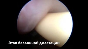 атрезия устья влагалища