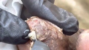 Jigger digging Harrison with edema and jiggers - watch full video @riseupsociety.net