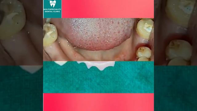 REMOVABLE PARTIAL DENTURE