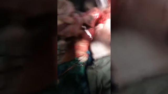 Разрыв нагноившей эхинококовой кисты 5 - 6 сегмента печени. смотреть онлайн
