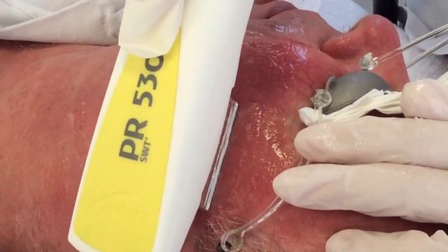 Фотоомоложение лица SWT смотреть онлайн