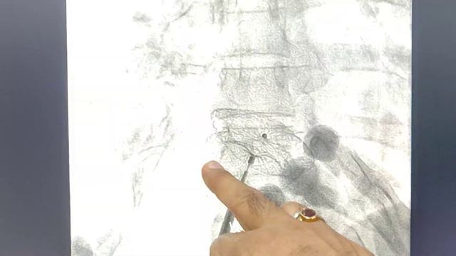 Amplatzer Device for ASD closure: Explained Prof Dr Vivek Gupta Sr Cardiologist Apollo hosp12.8.202 смотреть онлайн