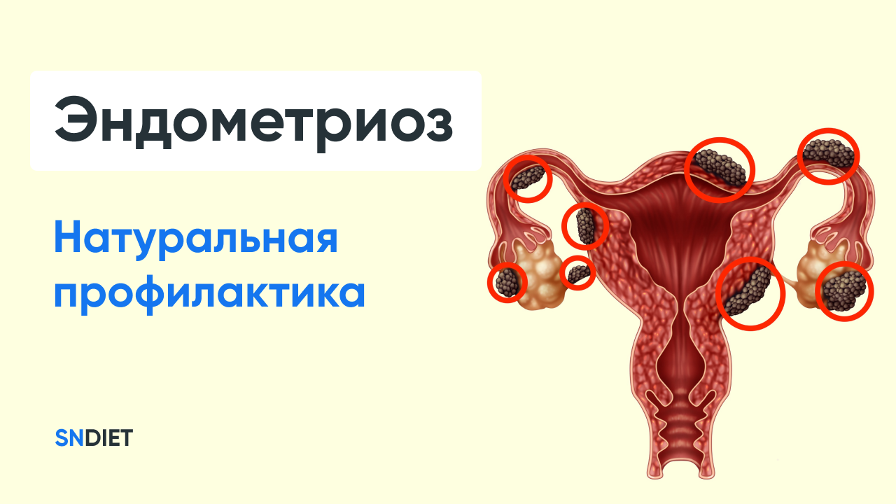 Эндометриоз - натуральная профилактика