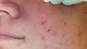 Acne extractions take 2, session 1. Blackheads, whiteheads, Ears. 20 minutes of just the pop. ASMR.