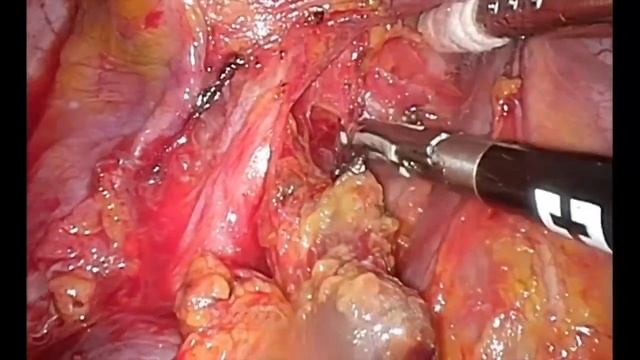 Asvide: Lymph node dissection in the right upper mediastinum. смотреть онлайн