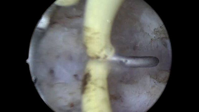 hysteroscopy metroplasty смотреть онлайн