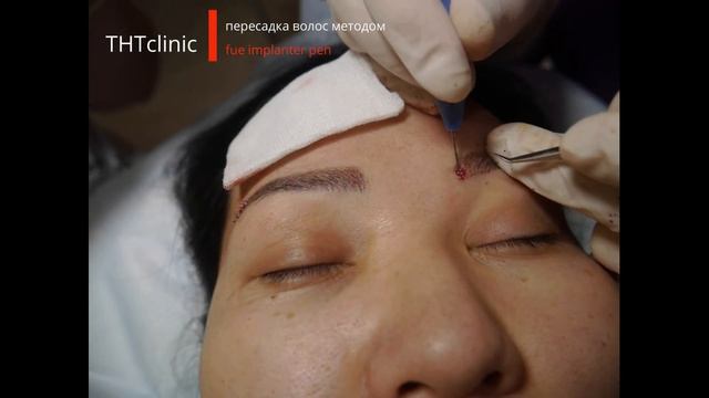 Пересадка волос на бровях - деликатное решение  за день)