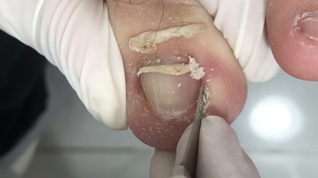 Long Strips Of Ingrown Nails Are Resolved【Crazy Pedicure Room】
