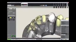 CAD CAM изготовление коронок из диоксида циркония