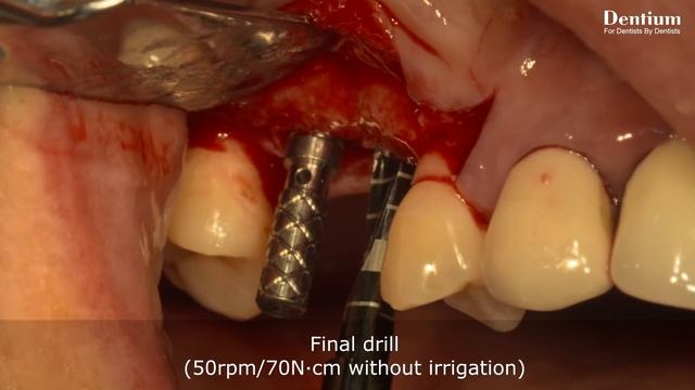 Hydraulic sinus lift technique using DASK & Dentium sinus kit смотреть онлайн