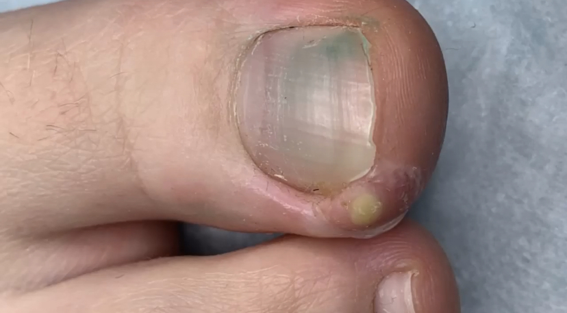 Вросший ноготь??⚠️?? смотреть онлайн