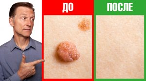 Как избавиться от бородавок и папиллом за 1 день?