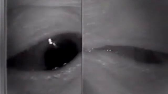 Aberrant Regeneration Of Third Nerve, Bilaterally (1 Degree OD, 2 Degrees OS)