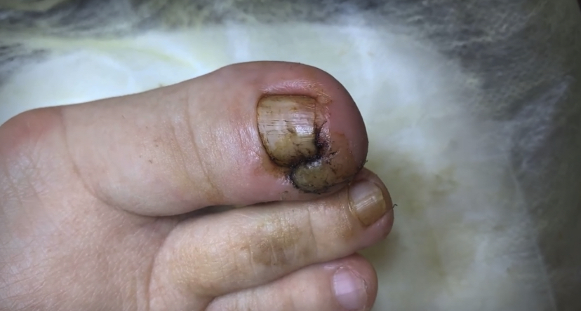 Вросший ноготь ??⚠️??? смотреть онлайн