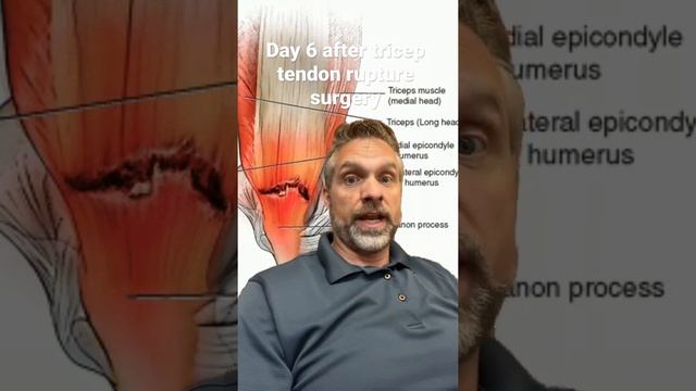 Day Six After Tricep Tendon Repair Surgery. Starting To Get Back To Normal But One Hand￼