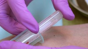 Бурсит локтевого сустава