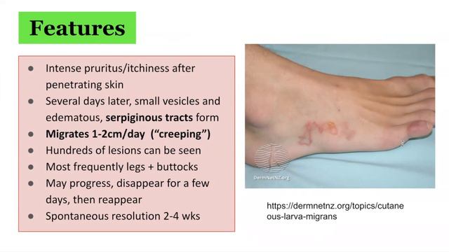 Cutaneous larva migrans: clinical features, associations, and management смотреть онлайн