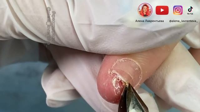 Преображение ❤️ Как восстановить ноготь после травмы ? 2 серия ? смотреть онлайн