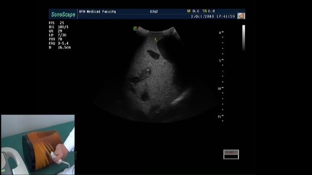 УЗИ селезенки:техника исследования. Проф. В. Изранов смотреть онлайн
