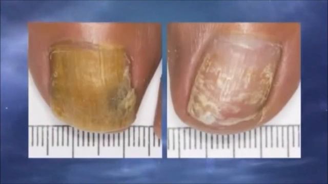 Toenail Fungus Removal Using Laser смотреть онлайн