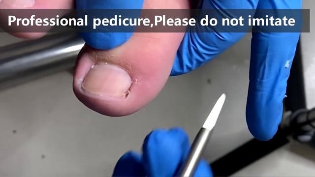 Pedicure tutorial ：Painless treatment of paronychia【Xue Yidao】 смотреть онлайн