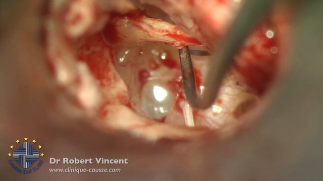 Revision ossiculoplasty for dislocated incus autograft Total ossicular chain reconstruction (TORP) смотреть онлайн