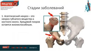 Остеохондропатия у детей. Болезнь Шинца. Массаж и реабилитация