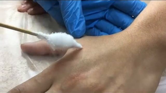 Криодеструкция.Техники удаления различных образований кожи с помощью жидкого азота смотреть онлайн