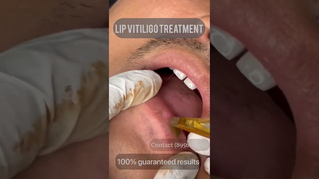 VITILIGO PERMANENT TREATMENT | VITILIGO CAMOUFLAGE TREATMENT | VITILIGO SKIN COLOUR TREATMENT. смотреть онлайн