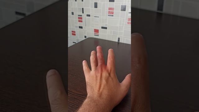 Как избавиться от укуса летучей мыши. Последствия укуса смотреть онлайн