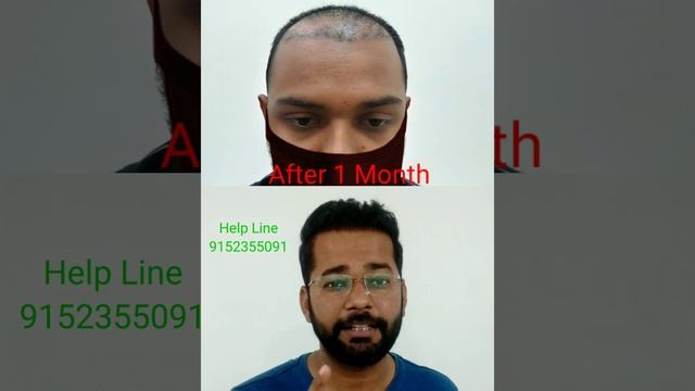 Amazing Hair Transplant Result in 9 Months | Amazing Hair Style #Short смотреть онлайн