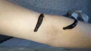 ?Как поставить пиявки?