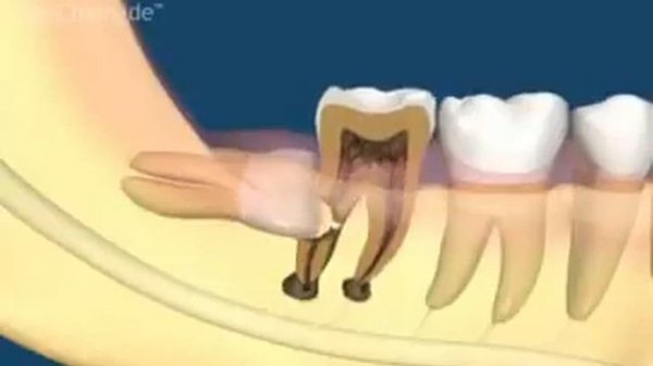 Сложное удаление зуба мудрости.