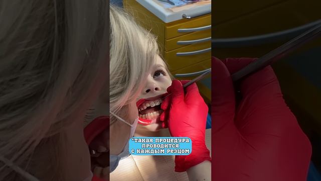 Фиксация частичной брекет-системы! #shorts