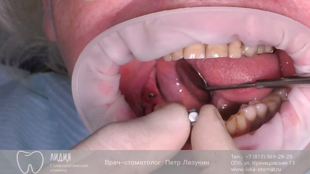 Удаление имплантатов Альфа-Био