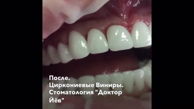 Виниры / veneers смотреть онлайн