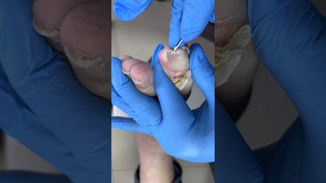 Pedicure Tutorial：Treatment Process For Curly Toenails 【Pedicure Master Lin Jun】