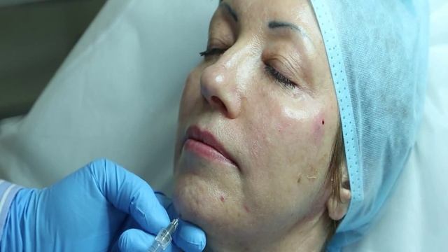 Контурная пластика филлерами Реванесс и Редексис смотреть онлайн