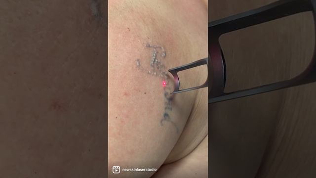 Goodbye Raymond tattoo removal смотреть онлайн