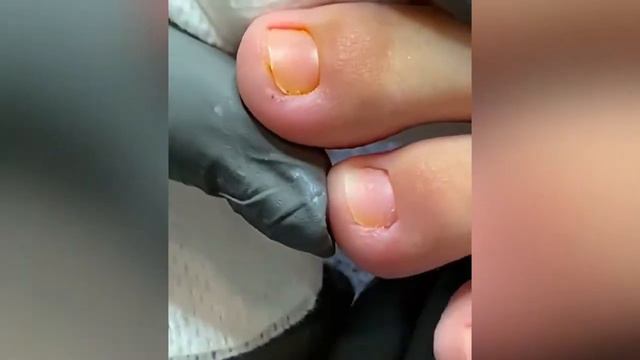 Воспаление у подростка при гипергидрозе🦶🏻❗️☝🏻 смотреть онлайн