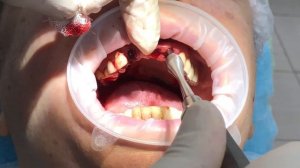 Одномоментная имплантация с удалением зубов? Возможно? #имплантация #клиникамосква #зубыдоипосле